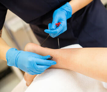 Dry-Needling