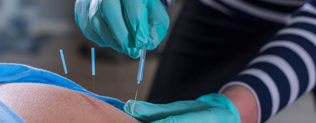 Dry Needling Greenville, SC